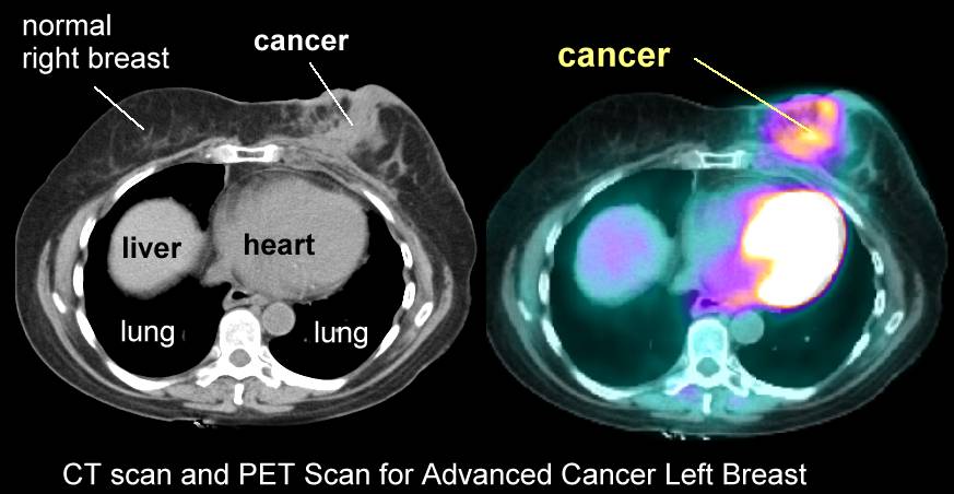 PET Scan | CANCER INSULEAN
